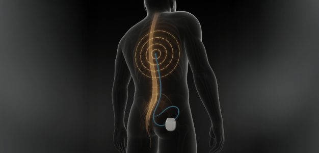 Epidural Stimülasyon Epidural Stimülasyon